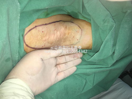 腋臭复发常见实例分析 手术