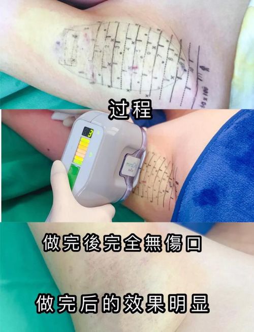 miradry清新微波 狐臭不再 狐 作非为